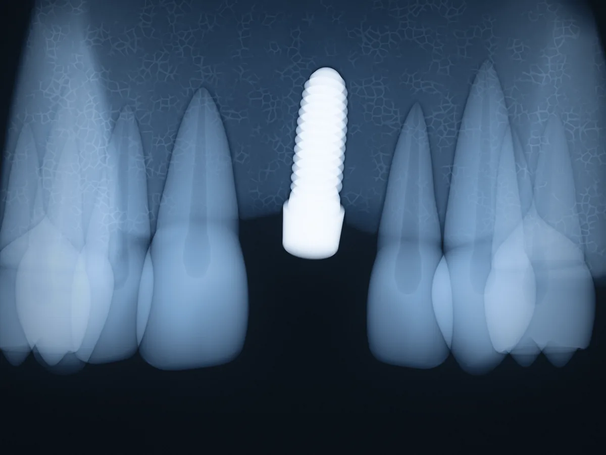Röntgenansicht: das eingesetzte Implantat im Knochen (Symbolbild)