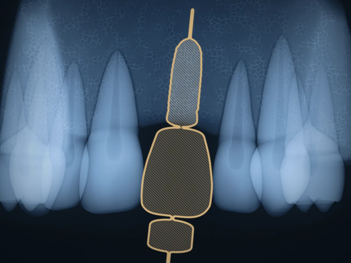 Geplantes Implantat als Umriss in der Lücke, darüber die Hülse der Bohrschablone (Symbolbild)